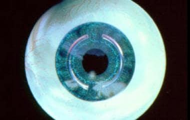 Intracorneal Ring Segments: Background, History of the Procedure,  Indications